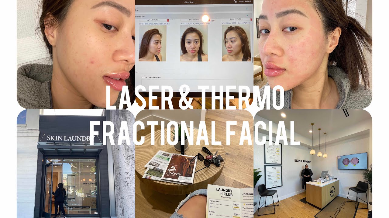 First laser & Thermo Fractional facial experience at Skin Laundry I What's Thermo Fractional facial?