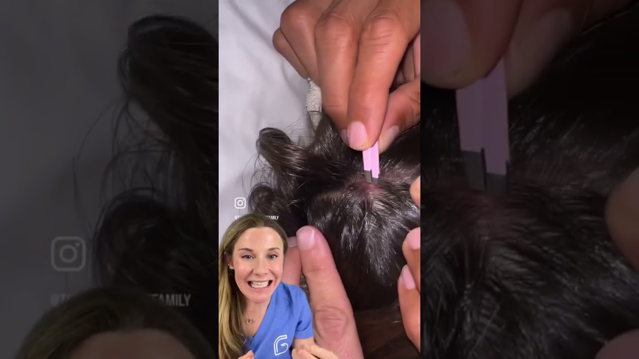 Dermatologist reacts to botfly extraction. Original video credit: the bucket list family. #botfly