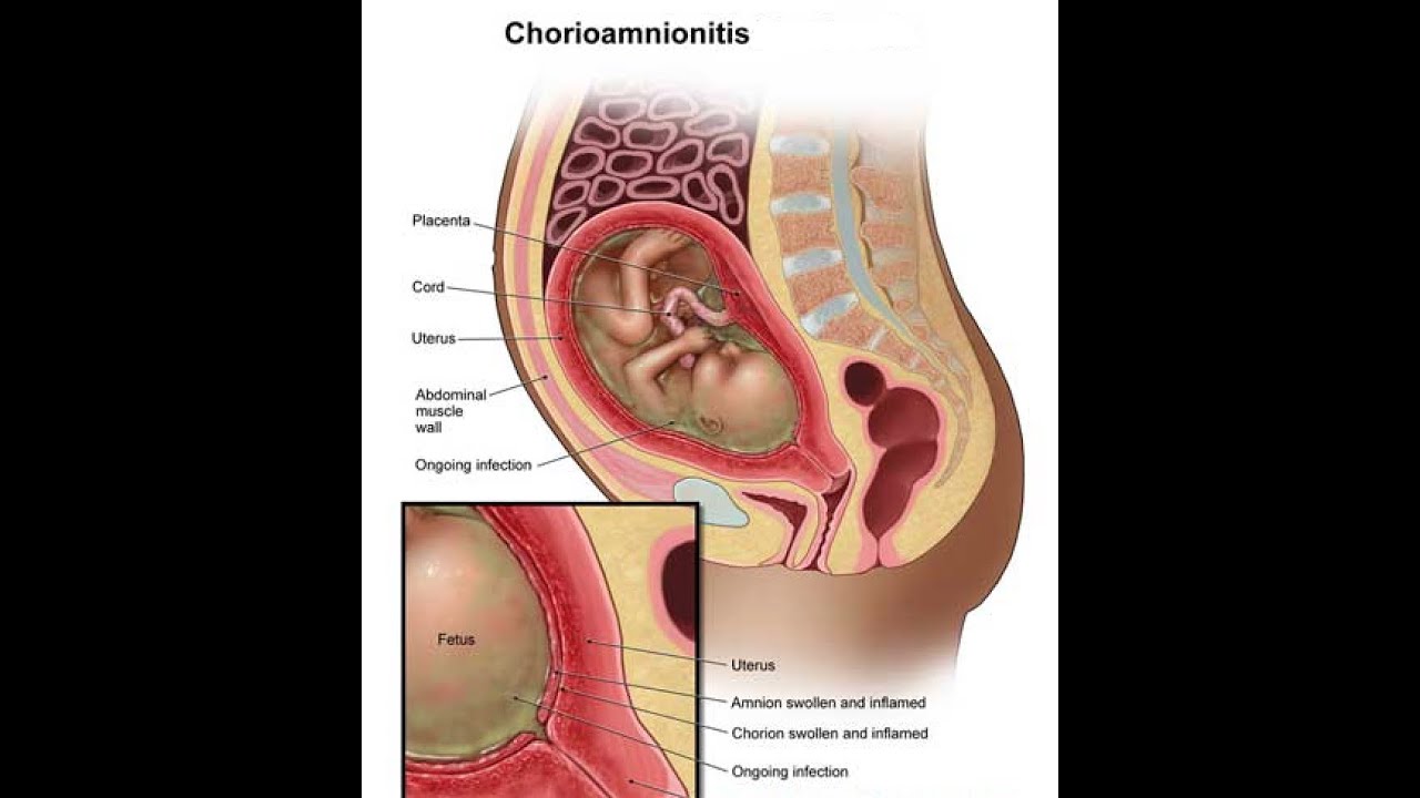Chorioamnionitis