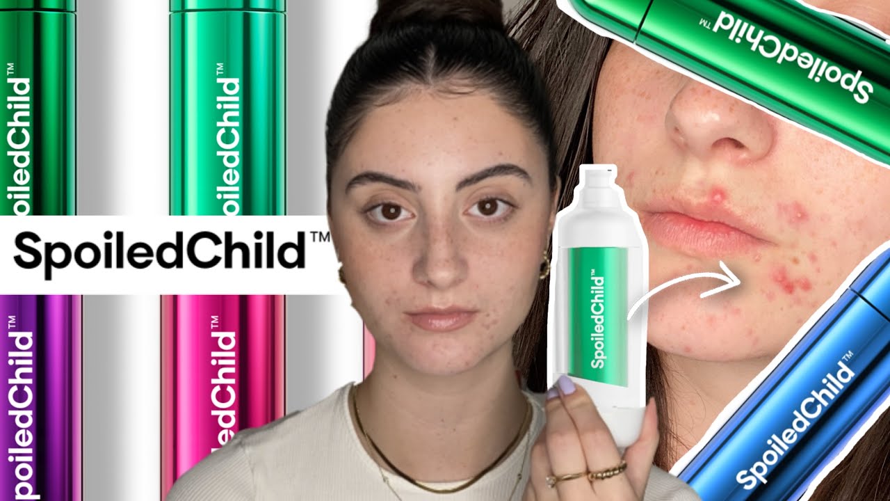 THE TRUTH ABOUT SpoiledChild AGE CONTROL SKINCARE | Review & Results After 1 Month on Acne Skin