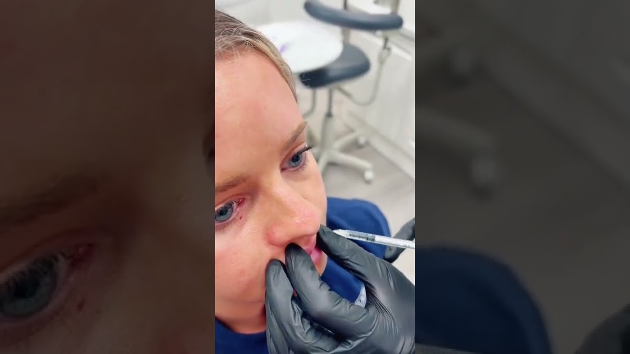 Lip Flip: Before & After