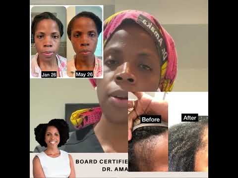 Plastic Surgeon Talks on Liquid Collagen that actually works & why
