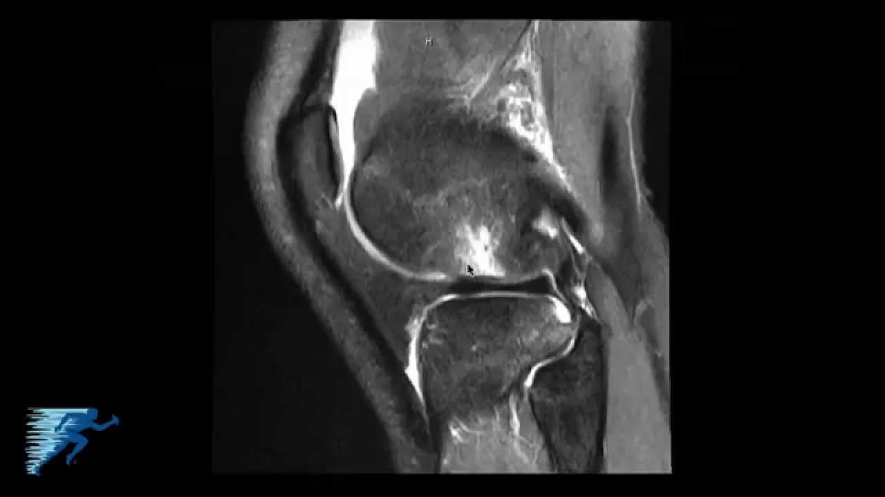 How to Read Knee MRI of ACL Tear | Anterior Cruciate Ligament Pain | Knee Surgery | Minneapolis, MN