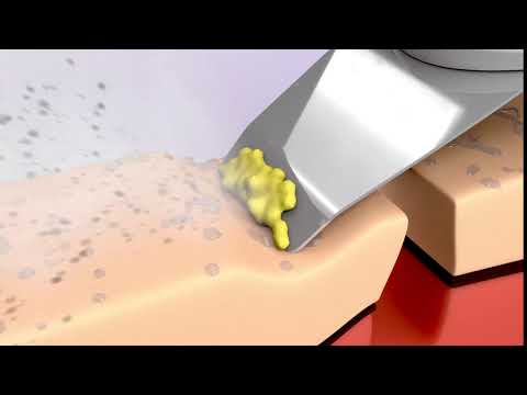 Ultrasonic Skin Spatula Cleansing | Ultrasonic Skin Scrubber Spatula | Blackhead Removal Exfoliation