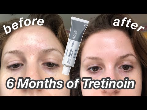 6 Month Tretinoin/Retin-A Update: Before & After + My Current Skincare Routine!