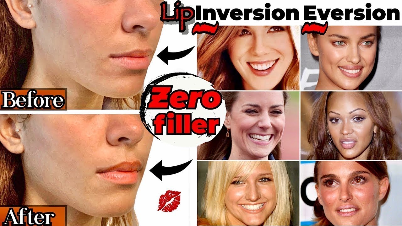 Botox Lip Flip Before and Afters | Everything you NEED to Know